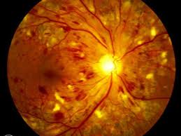 retinopatia diabetica antv